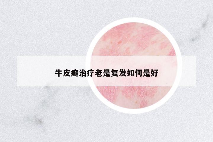 牛皮癬治療老是復(fù)發(fā)如何是好