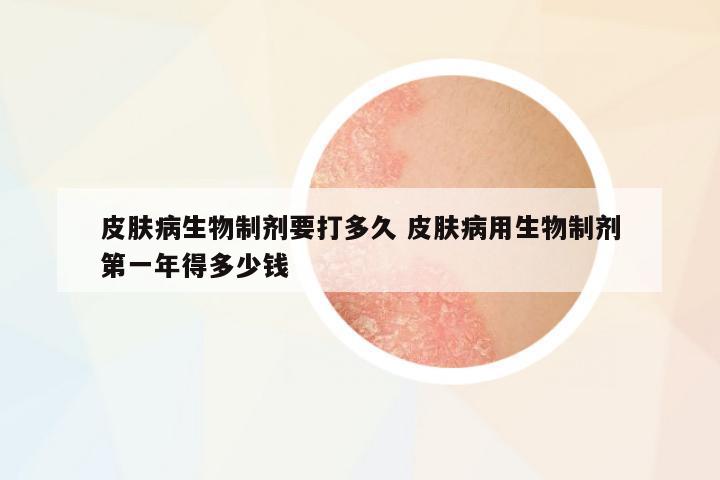 皮膚病生物制劑要打多久 皮膚病用生物制劑第一年得多少錢