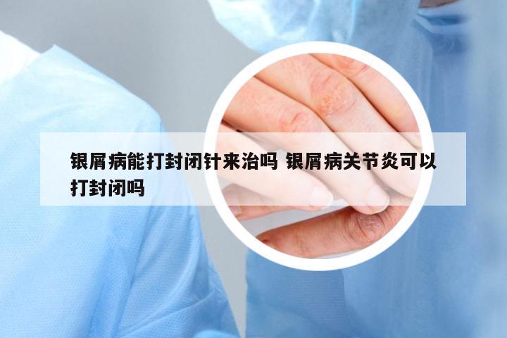 銀屑病能打封閉針來(lái)治嗎 銀屑病關(guān)節(jié)炎可以打封閉嗎
