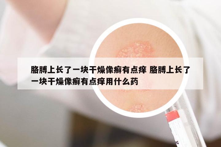 胳膊上長了一塊干燥像癬有點(diǎn)癢 胳膊上長了一塊干燥像癬有點(diǎn)癢用什么藥