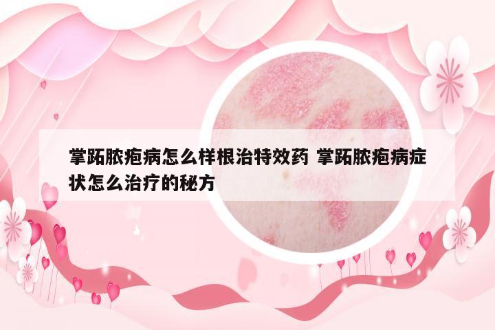 掌跖膿皰病怎么樣根治特效藥 掌跖膿皰病癥狀怎么治療的秘方