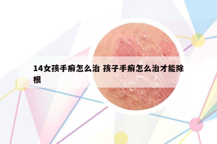 14女孩手癬怎么治 孩子手癬怎么治才能除根