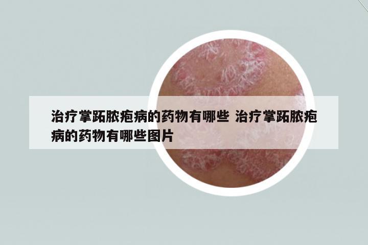 治療掌跖膿皰病的藥物有哪些 治療掌跖膿皰病的藥物有哪些圖片