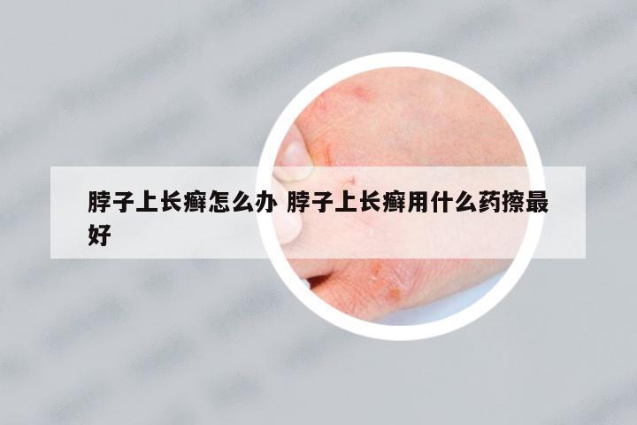 脖子上長癬怎么辦 脖子上長癬用什么藥擦最好