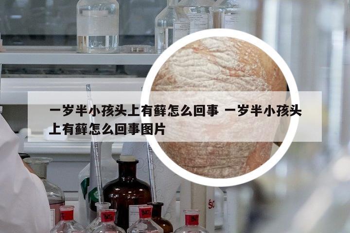 一歲半小孩頭上有蘚怎么回事 一歲半小孩頭上有蘚怎么回事圖片