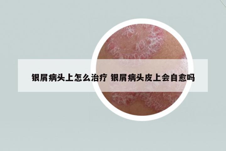 銀屑病頭上怎么治療 銀屑病頭皮上會自愈嗎