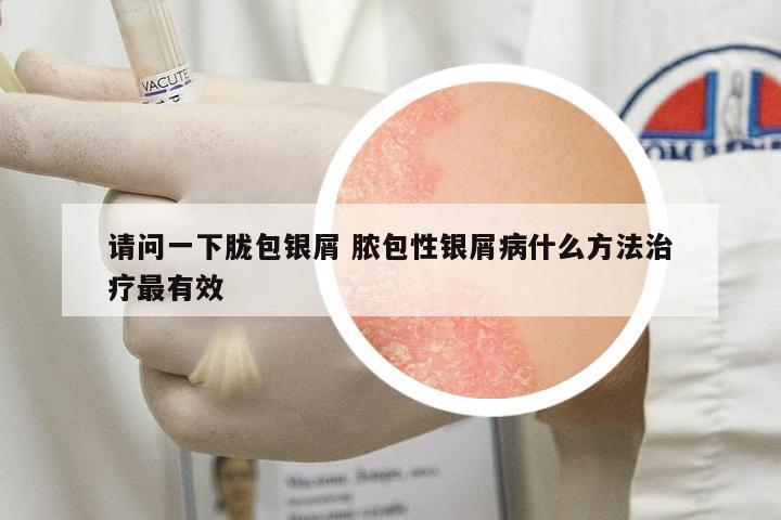 請(qǐng)問(wèn)一下朧包銀屑 膿包性銀屑病什么方法治療最有效