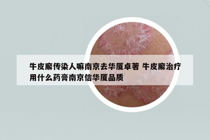 牛皮廨傳染人嘛南京去華廈卓著 牛皮廨治療用什么藥膏南京信華廈品質(zhì)