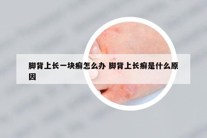腳背上長(zhǎng)一塊癬怎么辦 腳背上長(zhǎng)癬是什么原因