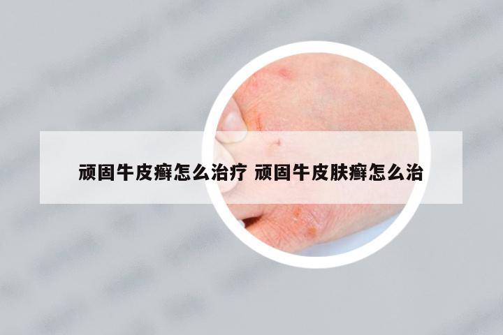 頑固牛皮癬怎么治療 頑固牛皮膚癬怎么治