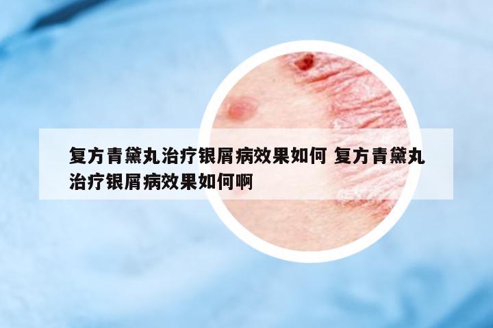 復(fù)方青黛丸治療銀屑病效果如何 復(fù)方青黛丸治療銀屑病效果如何啊