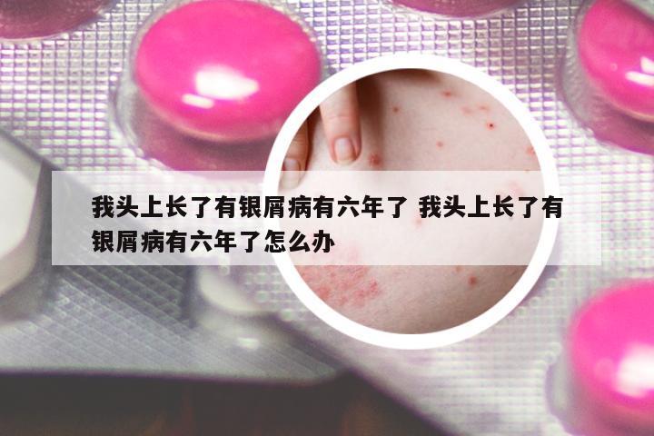 我頭上長了有銀屑病有六年了 我頭上長了有銀屑病有六年了怎么辦