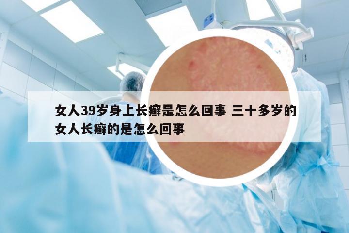 女人39歲身上長癬是怎么回事 三十多歲的女人長癬的是怎么回事