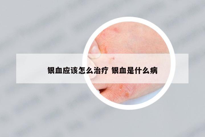 銀血應(yīng)該怎么治療 銀血是什么病