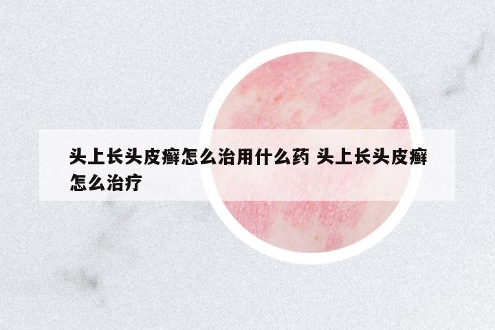 頭上長頭皮癬怎么治用什么藥 頭上長頭皮癬怎么治療