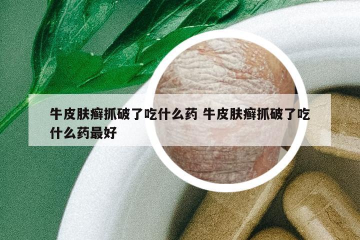 牛皮膚癬抓破了吃什么藥 牛皮膚癬抓破了吃什么藥最好
