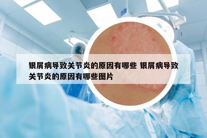 銀屑病導(dǎo)致關(guān)節(jié)炎的原因有哪些 銀屑病導(dǎo)致關(guān)節(jié)炎的原因有哪些圖片