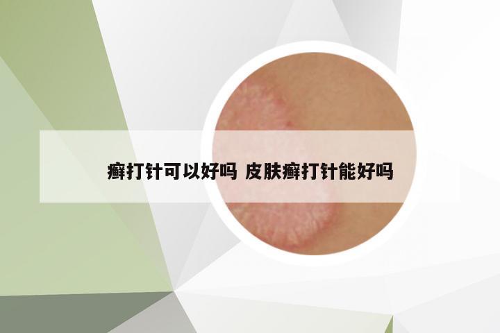 癬打針可以好嗎 皮膚癬打針能好嗎
