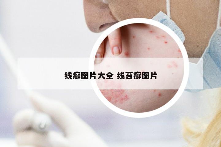 線癬圖片大全 線苔癬圖片