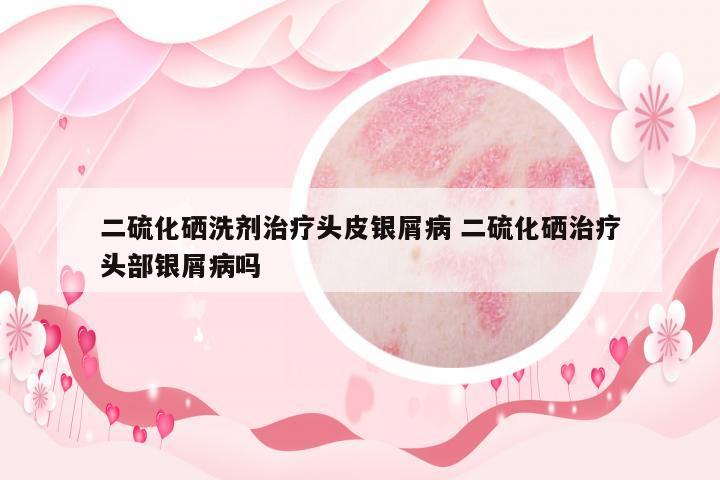 二硫化硒洗劑治療頭皮銀屑病 二硫化硒治療頭部銀屑病嗎