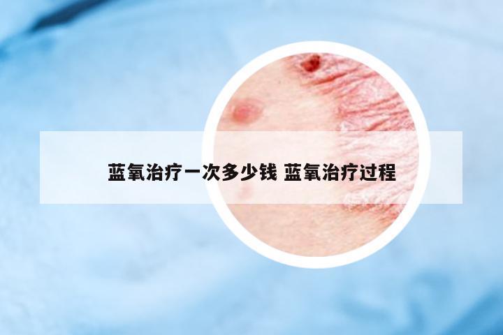 藍氧治療一次多少錢 藍氧治療過程