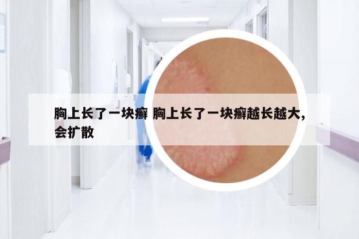 胸上長了一塊癬 胸上長了一塊癬越長越大,會(huì)擴(kuò)散