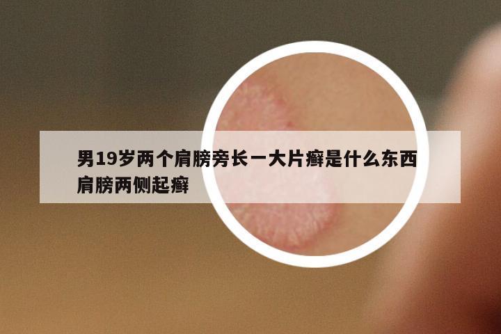 男19歲兩個肩膀旁長一大片癬是什么東西 肩膀兩側起癬