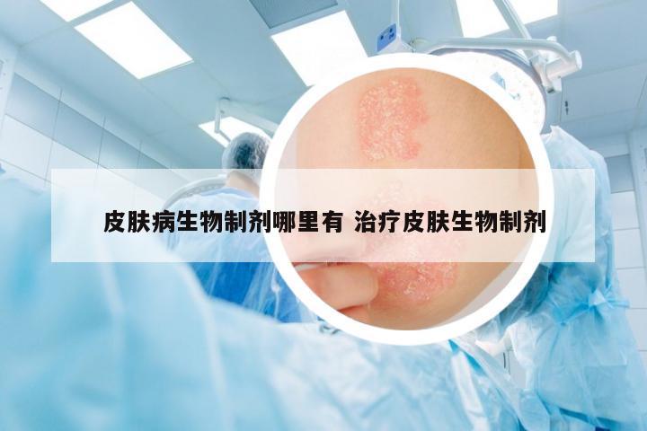 皮膚病生物制劑哪里有 治療皮膚生物制劑