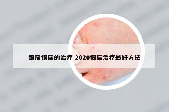銀屑銀屑的治療 2020銀屑治療最好方法