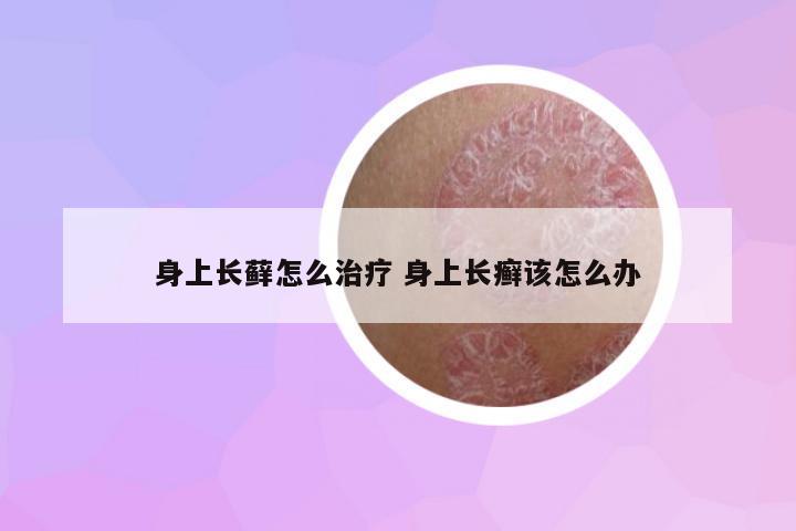 身上長(zhǎng)蘚怎么治療 身上長(zhǎng)癬該怎么辦