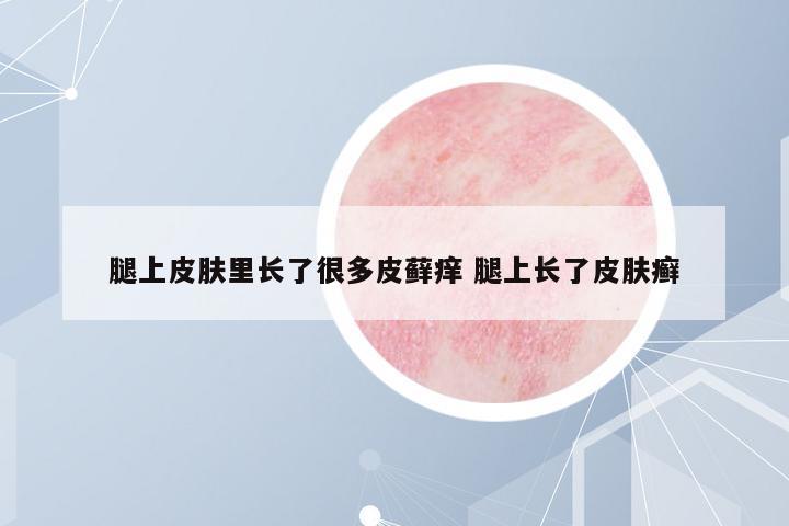 腿上皮膚里長(zhǎng)了很多皮蘚癢 腿上長(zhǎng)了皮膚癬