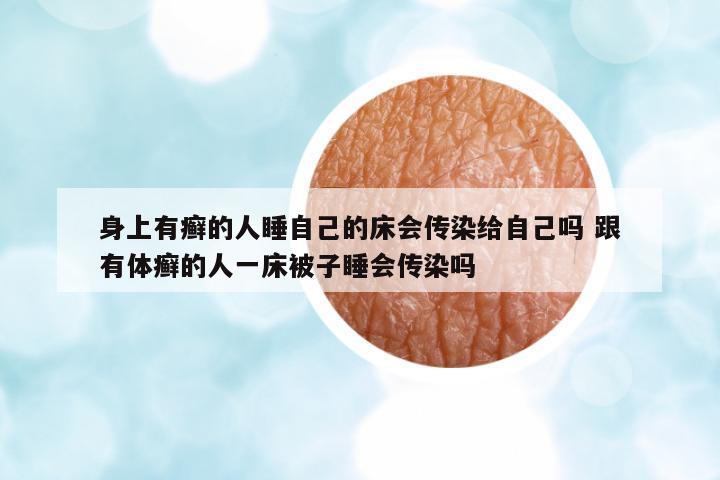 身上有癬的人睡自己的床會傳染給自己嗎 跟有體癬的人一床被子睡會傳染嗎