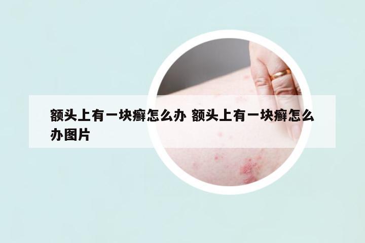 額頭上有一塊癬怎么辦 額頭上有一塊癬怎么辦圖片
