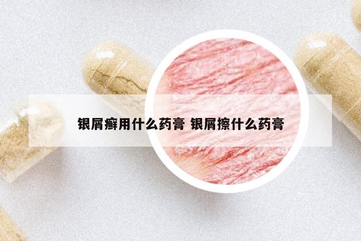 銀屑癬用什么藥膏 銀屑擦什么藥膏