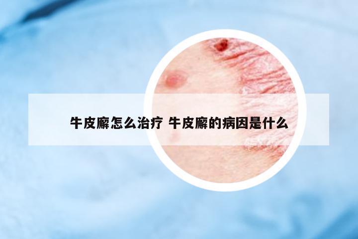 牛皮廨怎么治療 牛皮廨的病因是什么