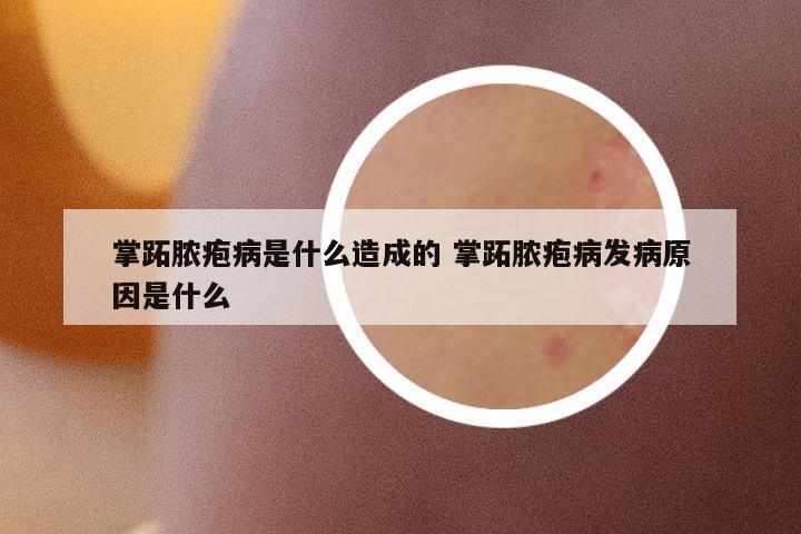 掌跖膿皰病是什么造成的 掌跖膿皰病發(fā)病原因是什么