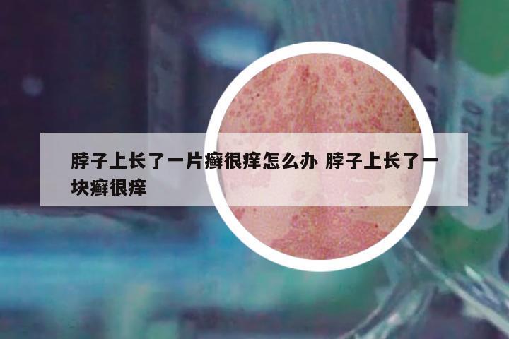 脖子上長了一片癬很癢怎么辦 脖子上長了一塊癬很癢
