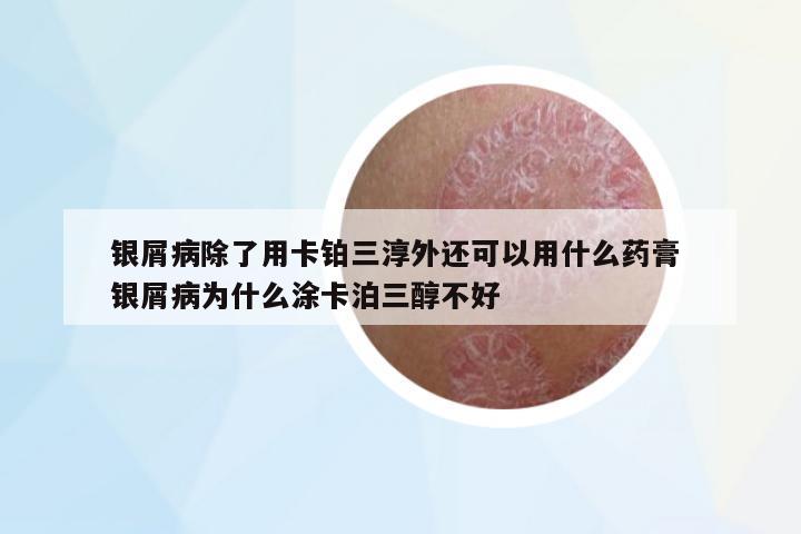 銀屑病除了用卡鉑三淳外還可以用什么藥膏 銀屑病為什么涂卡泊三醇不好