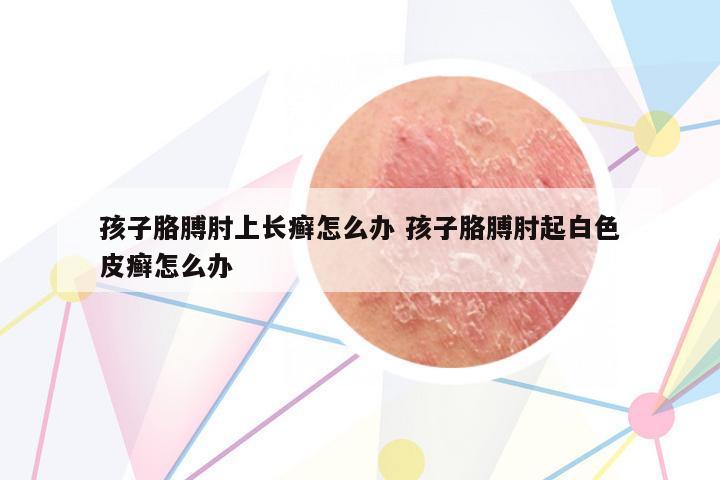孩子胳膊肘上長(zhǎng)癬怎么辦 孩子胳膊肘起白色皮癬怎么辦