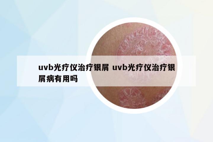 uvb光療儀治療銀屑 uvb光療儀治療銀屑病有用嗎