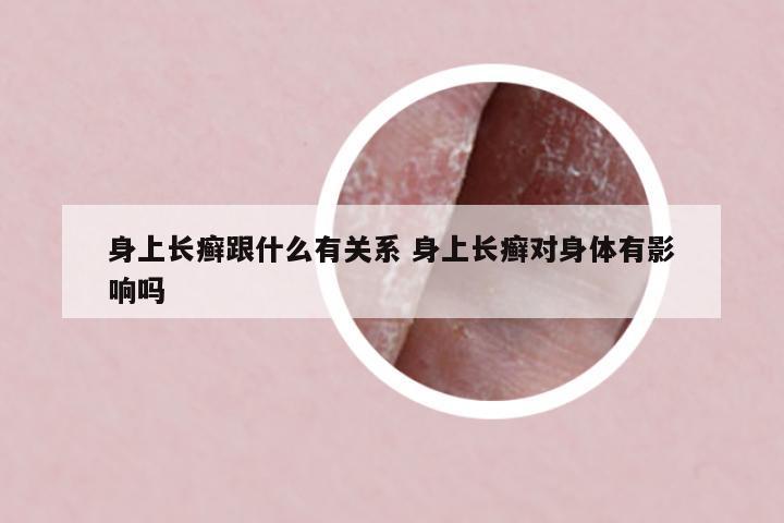 身上長(zhǎng)癬跟什么有關(guān)系 身上長(zhǎng)癬對(duì)身體有影響嗎