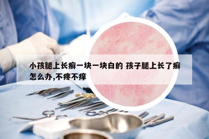 小孩腿上長癬一塊一塊白的 孩子腿上長了癬怎么辦,不疼不癢