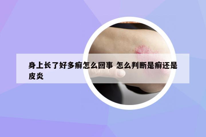 身上長了好多癬怎么回事 怎么判斷是癬還是皮炎
