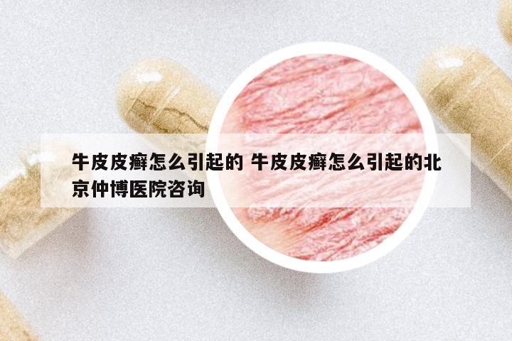 牛皮皮癬怎么引起的 牛皮皮癬怎么引起的北京仲博醫(yī)院咨詢