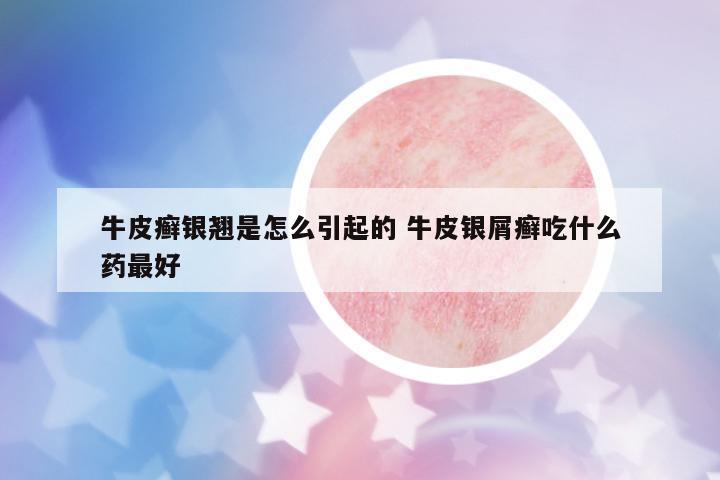 牛皮癬銀翹是怎么引起的 牛皮銀屑癬吃什么藥最好