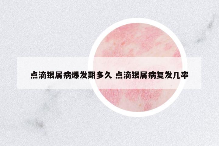 點滴銀屑病爆發(fā)期多久 點滴銀屑病復(fù)發(fā)幾率