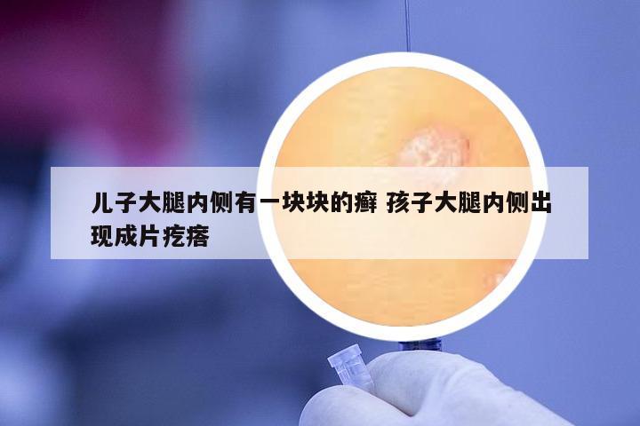 兒子大腿內(nèi)側(cè)有一塊塊的癬 孩子大腿內(nèi)側(cè)出現(xiàn)成片疙瘩