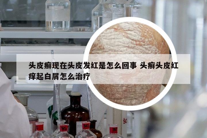 頭皮癬現(xiàn)在頭皮發(fā)紅是怎么回事 頭癬頭皮紅癢起白屑怎么治療