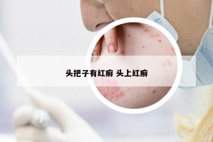 頭把子有紅癬 頭上紅癬