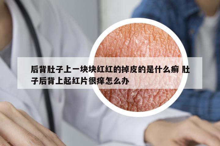 后背肚子上一塊塊紅紅的掉皮的是什么癬 肚子后背上起紅片很癢怎么辦